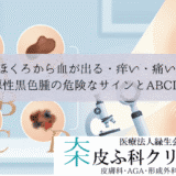 ほくろから血が出る・痒い・痛い｜悪性黒色腫（皮膚がん）の危険なサインとABCD