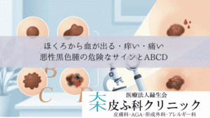 ほくろから血が出る・痒い・痛い｜悪性黒色腫（皮膚がん）の危険なサインとABCD