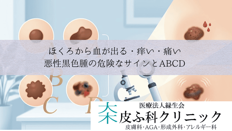ほくろから血が出る・痒い・痛い|悪性黒色腫(皮膚がん)の危険なサインとABCD