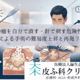 粉瘤を自分で潰す・針で刺す危険性｜癒着による手術の難易度上昇と再発リスク