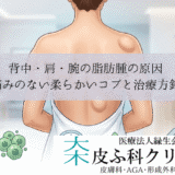 背中・肩・腕の脂肪腫の原因｜痛みのない柔らかいコブと治療方針