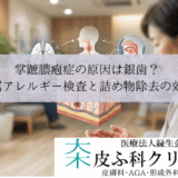 掌蹠膿疱症の原因は銀歯？｜歯科金属アレルギー検査と詰め物除去の効果
