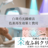 白斑の光線療法・エキシマライトとナローバンドUVB｜色素再生効果と費用