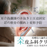 耳介偽嚢腫（じかいぎのうしゅ）の水抜きと圧迫固定｜耳の軟骨の腫れと変形予防