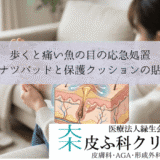 歩くと痛い魚の目の応急処置｜ドーナツパッドと保護クッションの貼り方