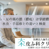 手のひら・足の裏の膿（膿疱）は掌蹠膿疱症？｜水虫・手湿疹との違いと検査