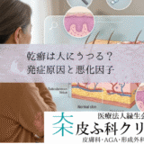 乾癬は人にうつる？｜遺伝・ストレス・メタボなど発症原因と悪化因子
