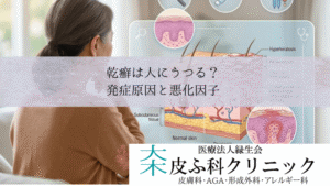 乾癬は人にうつる?|遺伝・ストレス・メタボなど発症原因と悪化因子