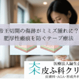 帝王切開の傷跡がミミズ腫れに？｜肥厚性瘢痕を防ぐアトファインとテープ療法
