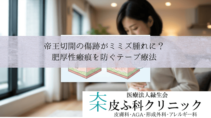 帝王切開の傷跡がミミズ腫れに？｜肥厚性瘢痕を防ぐアトファインとテープ療法