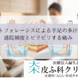 イオントフォレーシスによる手足の多汗症治療｜通院頻度とビリビリする痛み