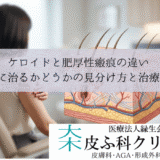 ケロイドと肥厚性瘢痕の違い｜自然に治るかどうかの見分け方と治療方針