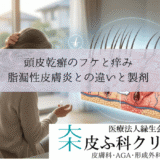 頭皮乾癬のフケと痒み｜脂漏性皮膚炎との違いとローション・シャンプー製剤