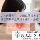 ピアス肉芽のクエン酸・ホットソークは効果ある？｜自己判断の危険性と正しい治療