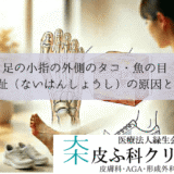 足の小指の外側のタコ・魚の目|内反小趾(ないはんしょうし)の原因と靴選び