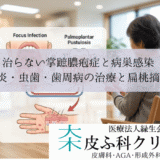 治らない掌蹠膿疱症と病巣感染｜扁桃炎・虫歯・歯周病の治療と扁桃摘出術