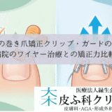市販の巻き爪矯正クリップ・ガードの効果｜病院のワイヤー治療との矯正力比較