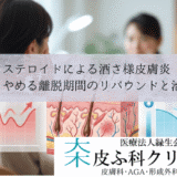 ステロイドによる酒さ様皮膚炎｜薬をやめる離脱期間のリバウンドと治療