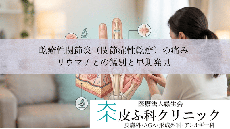 乾癬性関節炎（関節症性乾癬）の痛み｜リウマチとの鑑別と早期発見