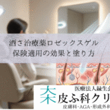 酒さ治療薬ロゼックスゲル（メトロニダゾール）｜保険適用の効果と塗り方