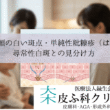 子供の顔の白い斑点・単純性粃糠疹（はたけ）｜尋常性白斑との見分け方