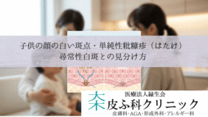 子供の顔の白い斑点・単純性粃糠疹(はたけ)|尋常性白斑との見分け方