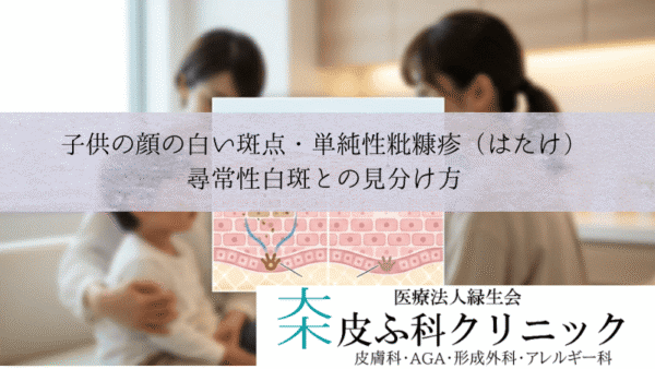 子供の顔の白い斑点・単純性粃糠疹（はたけ）｜尋常性白斑との見分け方