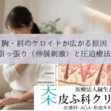 胸・肩のケロイドが広がる原因｜皮膚の引っ張り（伸展刺激）と圧迫療法のコツ