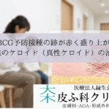 『BCG予防接種の跡が赤く盛り上がる｜子供のケロイド（真性ケロイド）の治療