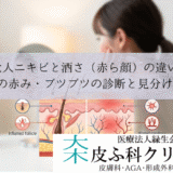 大人ニキビと酒さ（赤ら顔）の違い｜顔の赤み・ブツブツの診断と見分け方