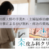 相模大野の手荒れ・主婦湿疹治療｜水仕事によるひび割れ・痒みの薬処方