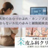 相模大野のおむつかぶれ・カンジダ皮膚炎｜治らないお尻の赤みと顕微鏡検査