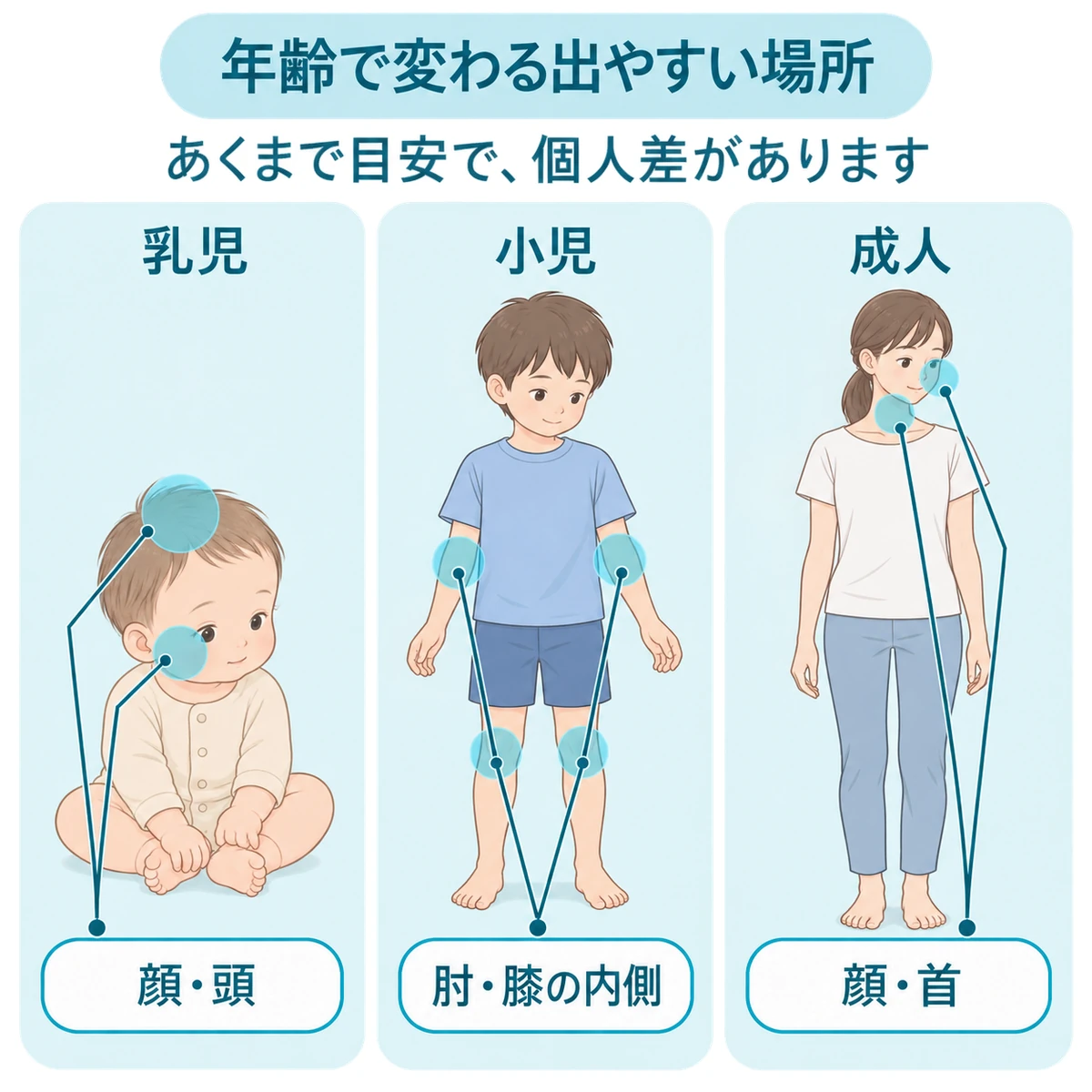乳児、小児、成人で湿疹が出やすい部位の違いを示した年齢別の図