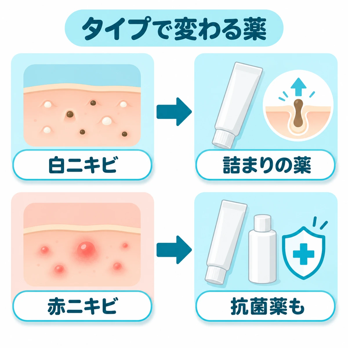 白ニキビには詰まりの薬、赤ニキビには抗菌薬も用いる選び分けの図