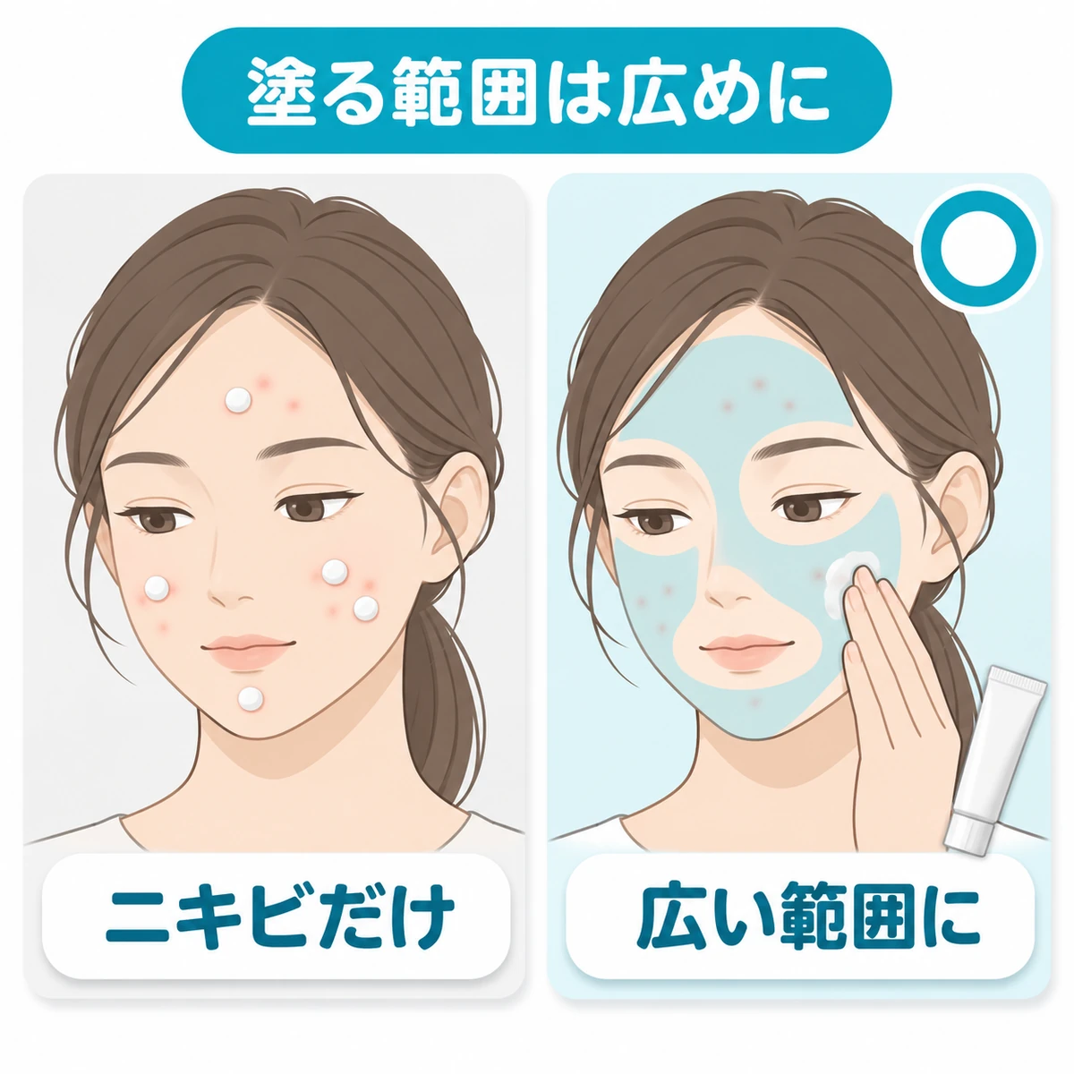 ニキビ薬を目や口のまわりを避けて顔の広い範囲に塗る方法を比べた図