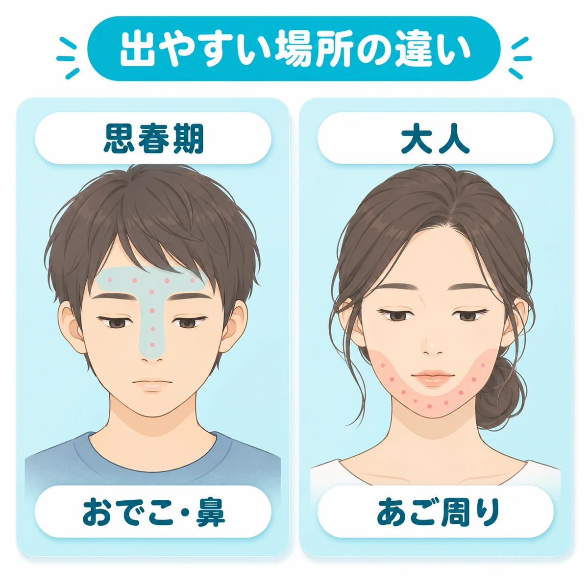 思春期はおでこ・鼻、大人はあご周りにニキビが出やすい違いを顔の図で比較