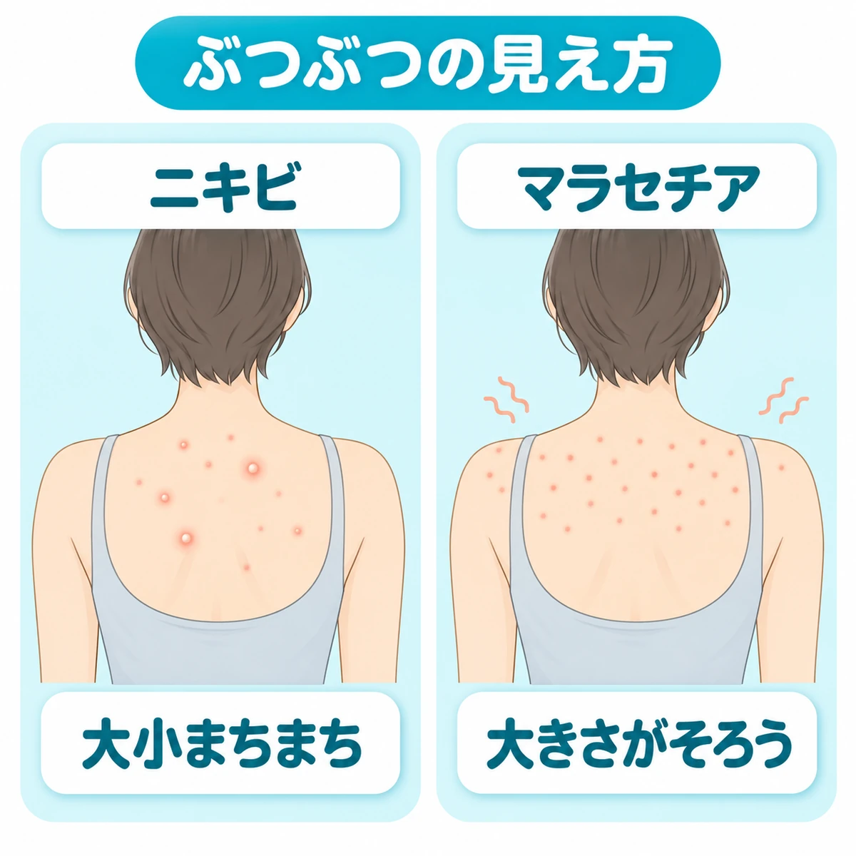 背中にできるニキビとマラセチア毛包炎のぶつぶつの大きさや広がり方を左右で見比べた図