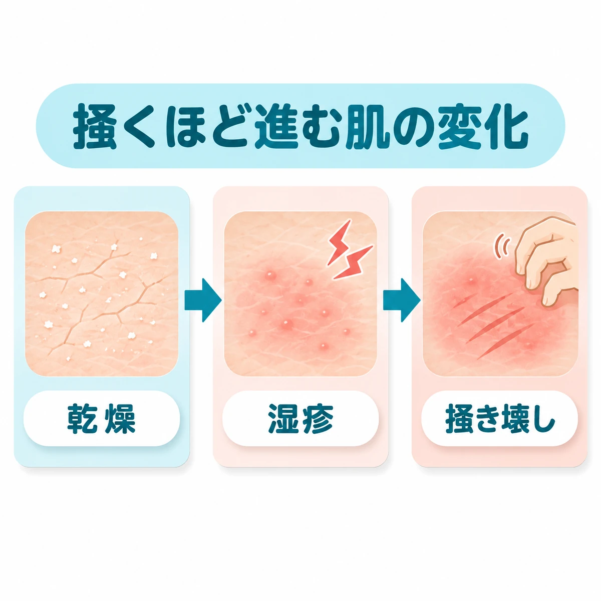 乾燥から湿疹、掻き壊しへ進む肌の変化を3段階で描いた図