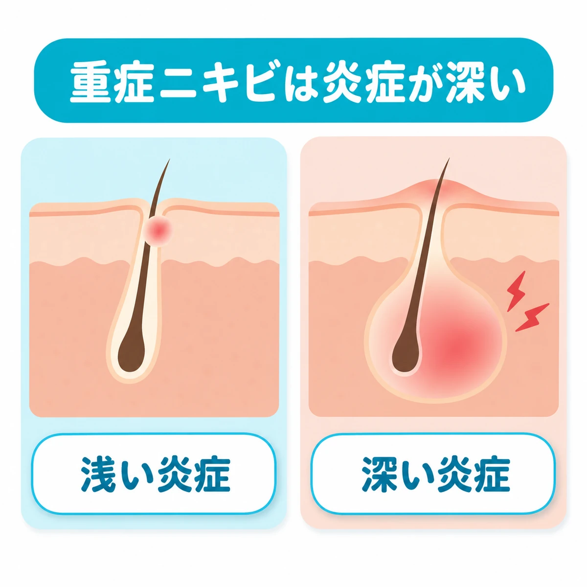 皮膚の断面で浅い炎症と深い炎症を比べ、深部の腫れと痛みを描いた図