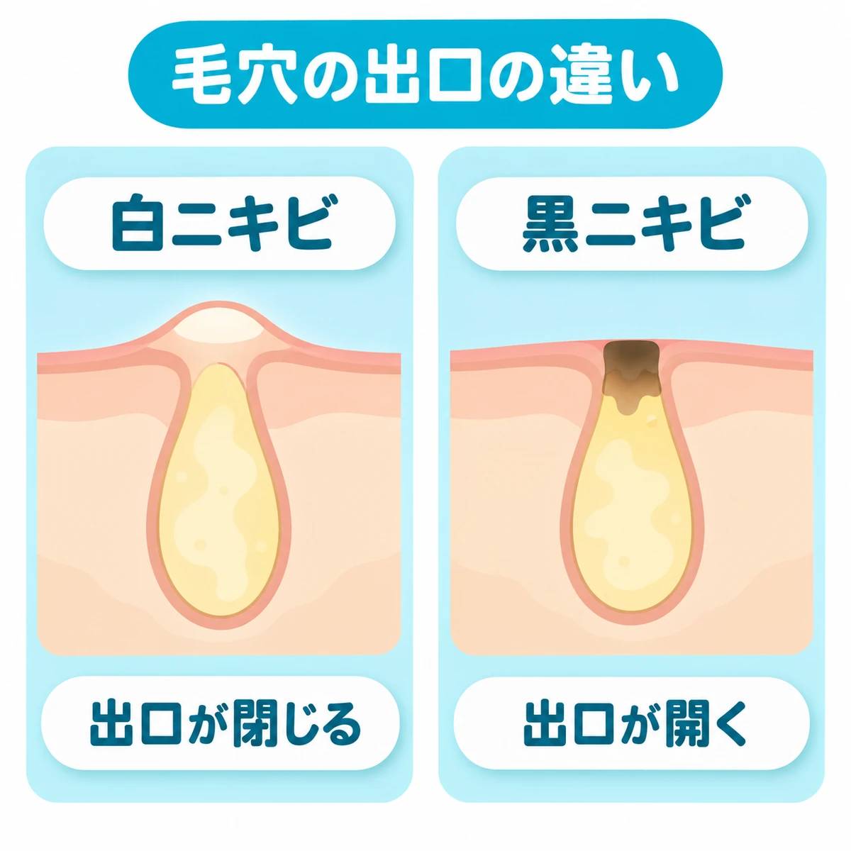 白ニキビと黒ニキビで異なる毛穴の出口の状態を比べた図