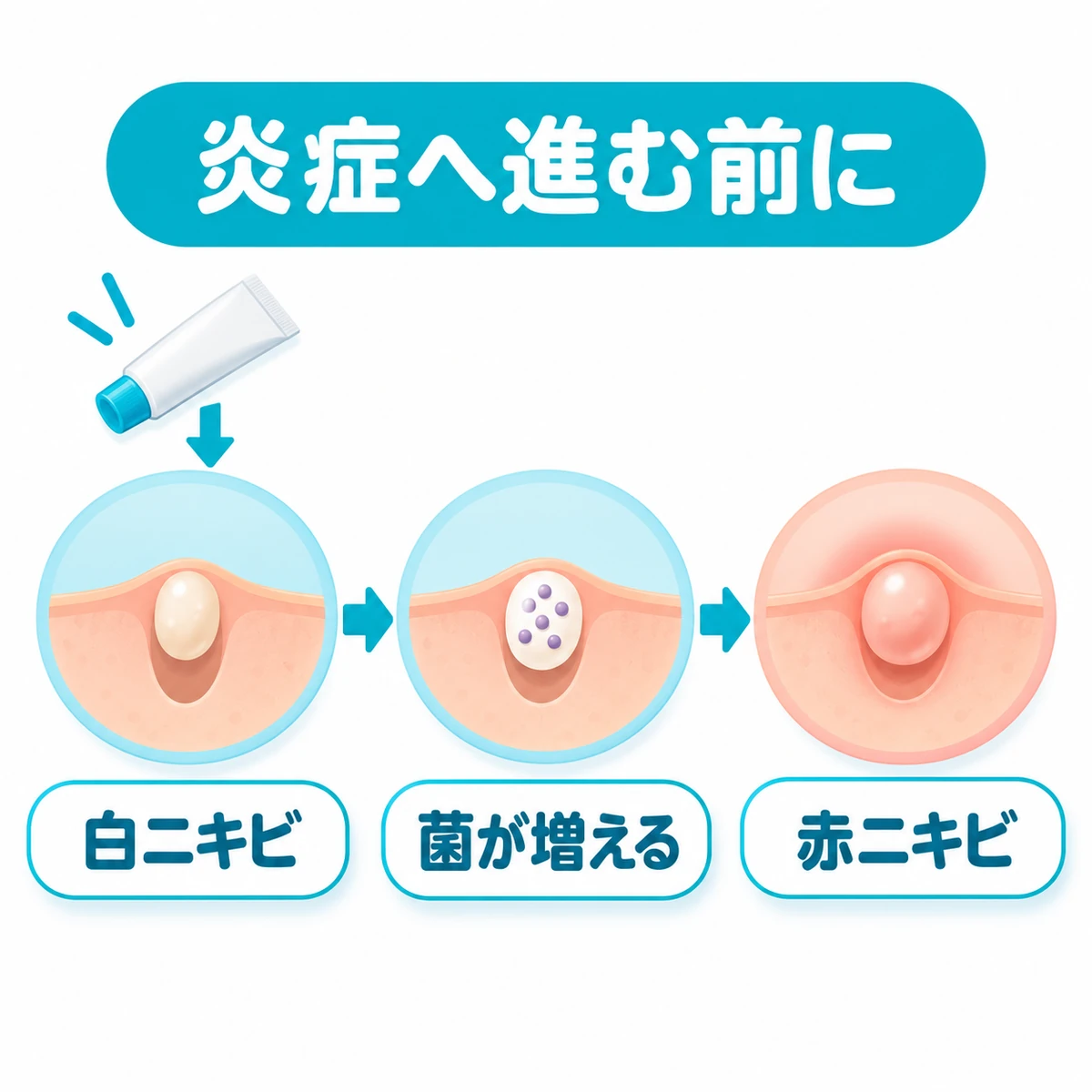 白ニキビから菌が増えて赤ニキビへ進む過程と早期の塗り薬を描いた図